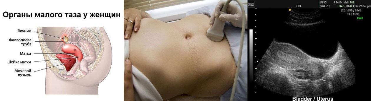 5 неделя операция. Ультразвуковое исследование органов малого таза трансабдоминальное. Трансабдоминальное УЗИ органов малого. Трансабдоминальное УЗИ малого таза. УЗИ малого таза у женщин при беременности.
