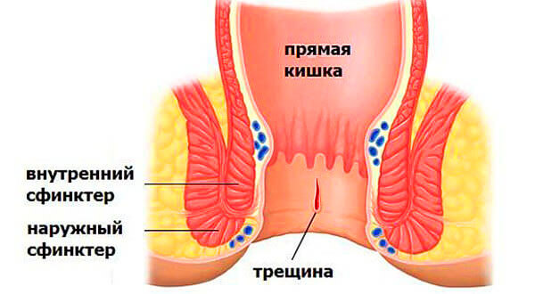 Консультация проктолога и лечение проктологических заболеваний в Алматы